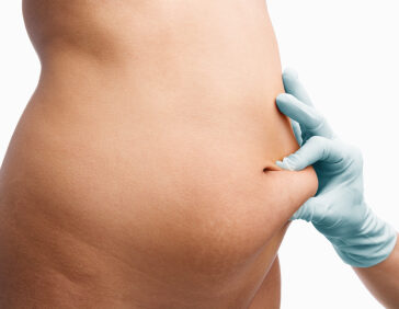 liposuction in Lahore without anesthesia