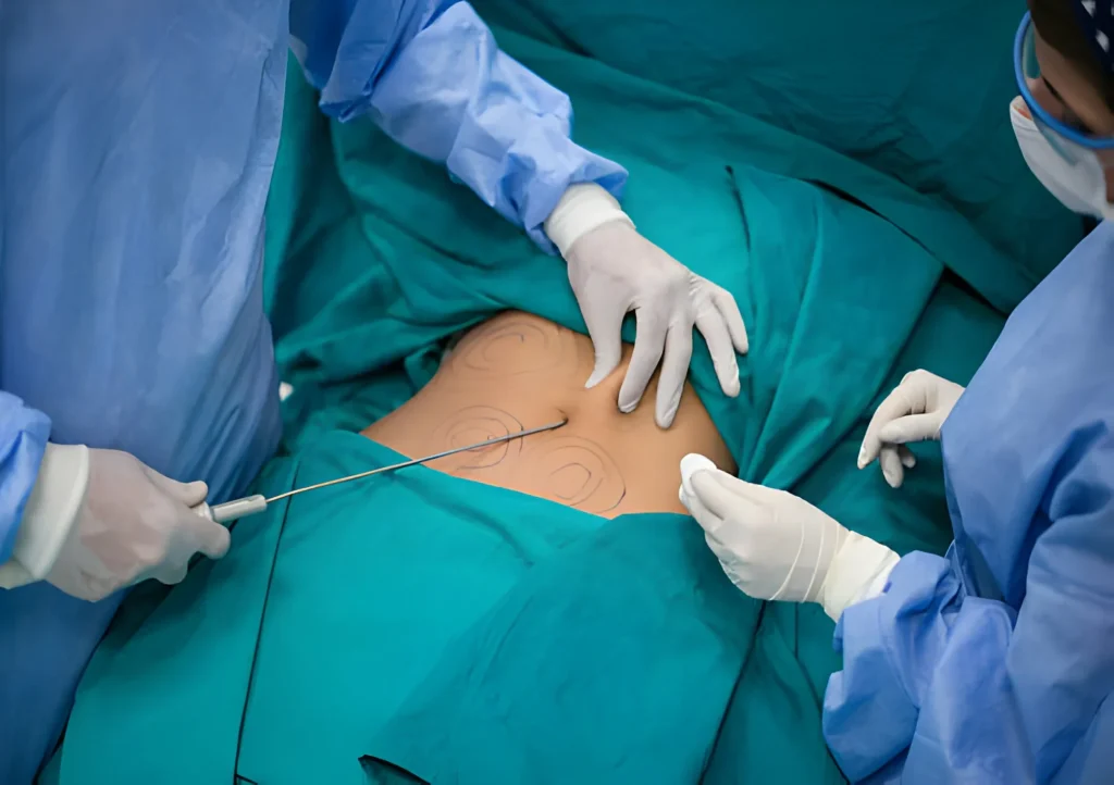 Liposuction Specialist in Lahore