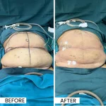 liposuction-2