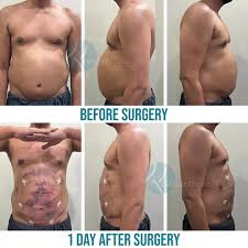 Liposuction Treatment